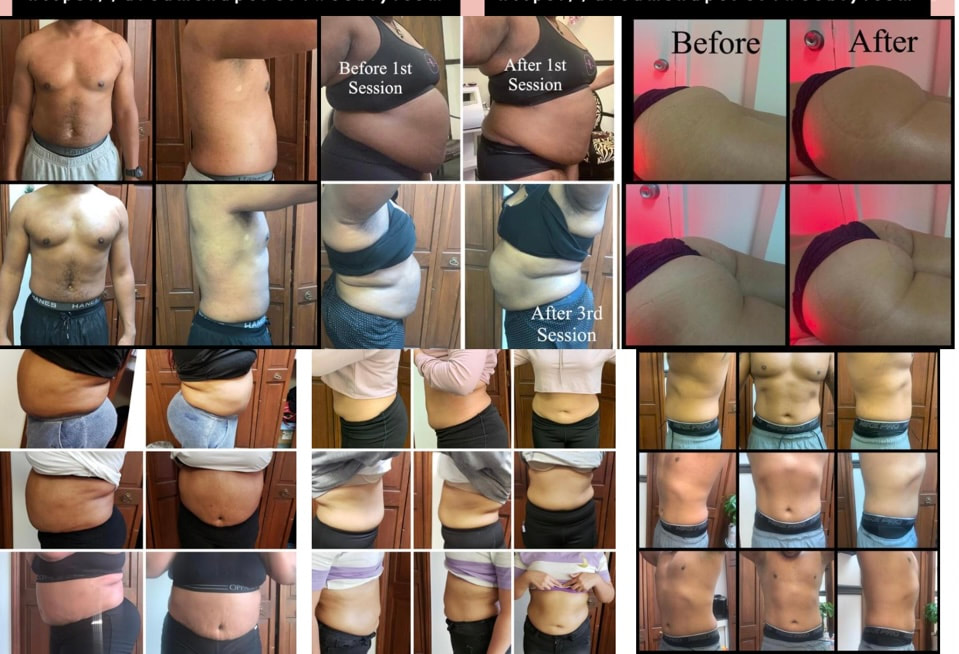 Dream Shape client progress photos showing individual body contouring experiences